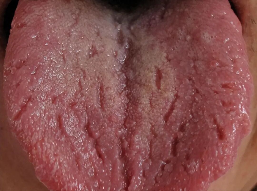 舌头有裂纹，一定是肾精亏虚吗？老中医教你1招，修复裂纹舌！