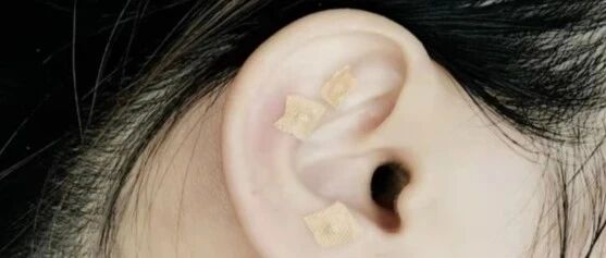 小药籽，大健康！——耳穴疗法，您了解吗？