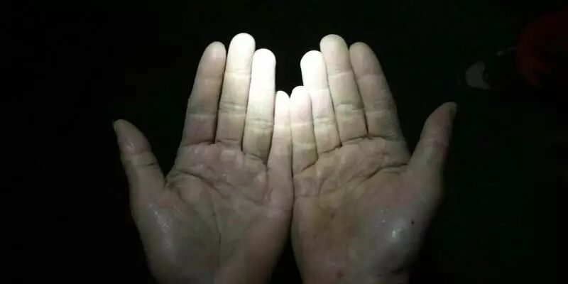 虹口供水管理所维修人员高师傅被冰水冻僵的手