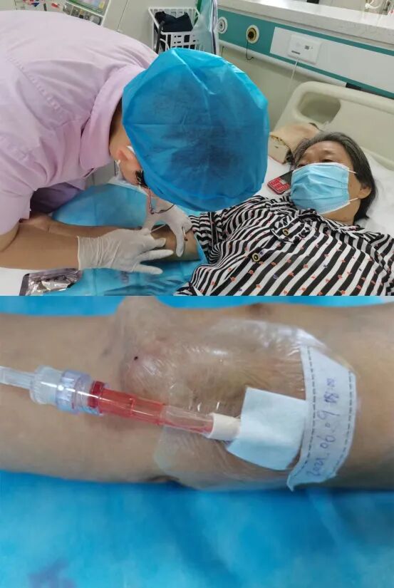 为什么要用动脉留置针我的“针”心只为你——晋中市中医院透析用留置针在动静脉内瘘穿刺中的应用_https://www.jmylbn.com_新闻资讯_第7张