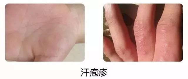 【健康】你手腳上有這種水泡嗎？注意了！ 健康 第7張