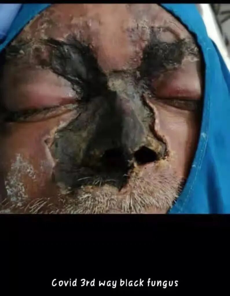 像这种感染者,真菌从鼻部开始扩散,很快覆盖头部的皮肤,然后从眼部