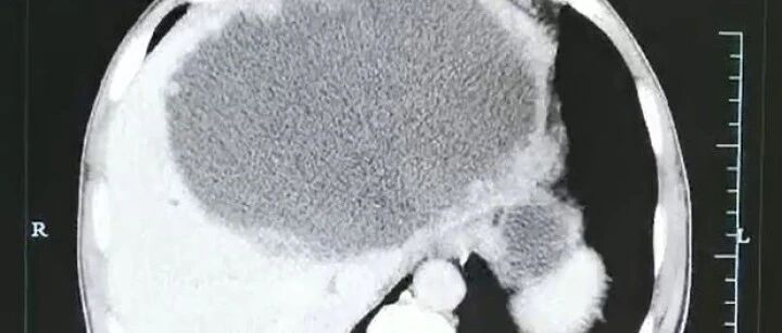 男子左肝被掏空，壁上布满密密麻麻的虫卵，只因吃了…