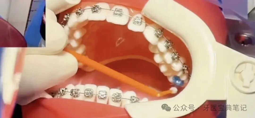 正畸时后牙垫高操作全流程！