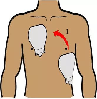 为什么选择双相波同步电复律？到底怎么回事？心电监护演示同步电复律全过程！_https://www.jmylbn.com_新闻资讯_第36张