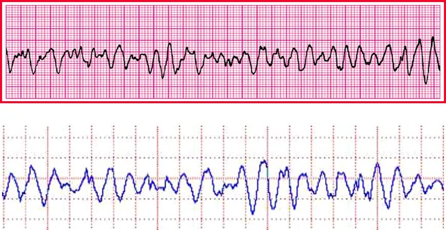为什么选择双相波同步电复律？到底怎么回事？心电监护演示同步电复律全过程！_https://www.jmylbn.com_新闻资讯_第23张