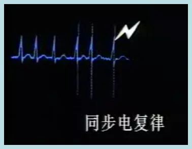 为什么选择双相波同步电复律？到底怎么回事？心电监护演示同步电复律全过程！_https://www.jmylbn.com_新闻资讯_第42张