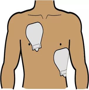 为什么选择双相波同步电复律？到底怎么回事？心电监护演示同步电复律全过程！_https://www.jmylbn.com_新闻资讯_第33张