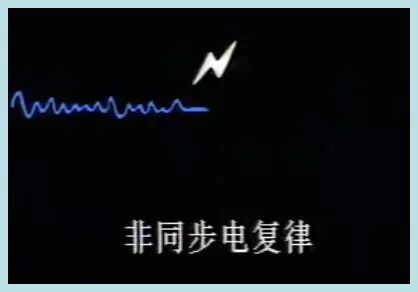 为什么选择双相波同步电复律？到底怎么回事？心电监护演示同步电复律全过程！_https://www.jmylbn.com_新闻资讯_第43张