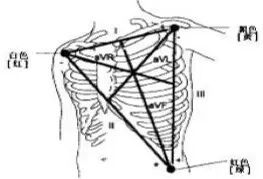 心电监护仪怎么看图解心电监护仪，那些基础知识你掌握了没？_https://www.jmylbn.com_新闻资讯_第4张