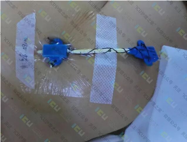 为什么要用推注泵PICC、CVC使用及维护_https://www.jmylbn.com_新闻资讯_第6张