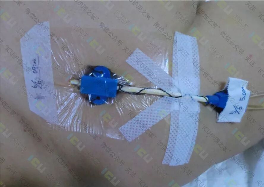 为什么要用推注泵PICC、CVC使用及维护_https://www.jmylbn.com_新闻资讯_第7张