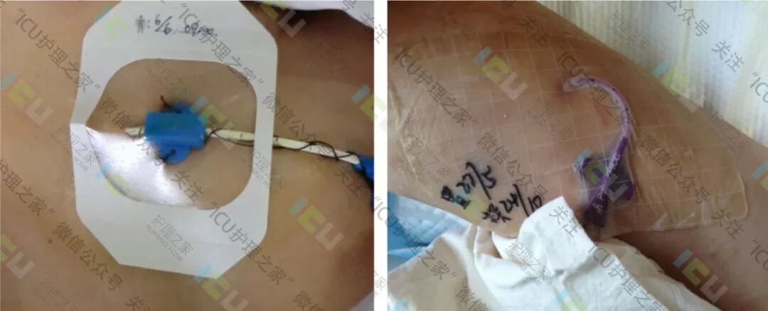 为什么要用推注泵PICC、CVC使用及维护_https://www.jmylbn.com_新闻资讯_第5张