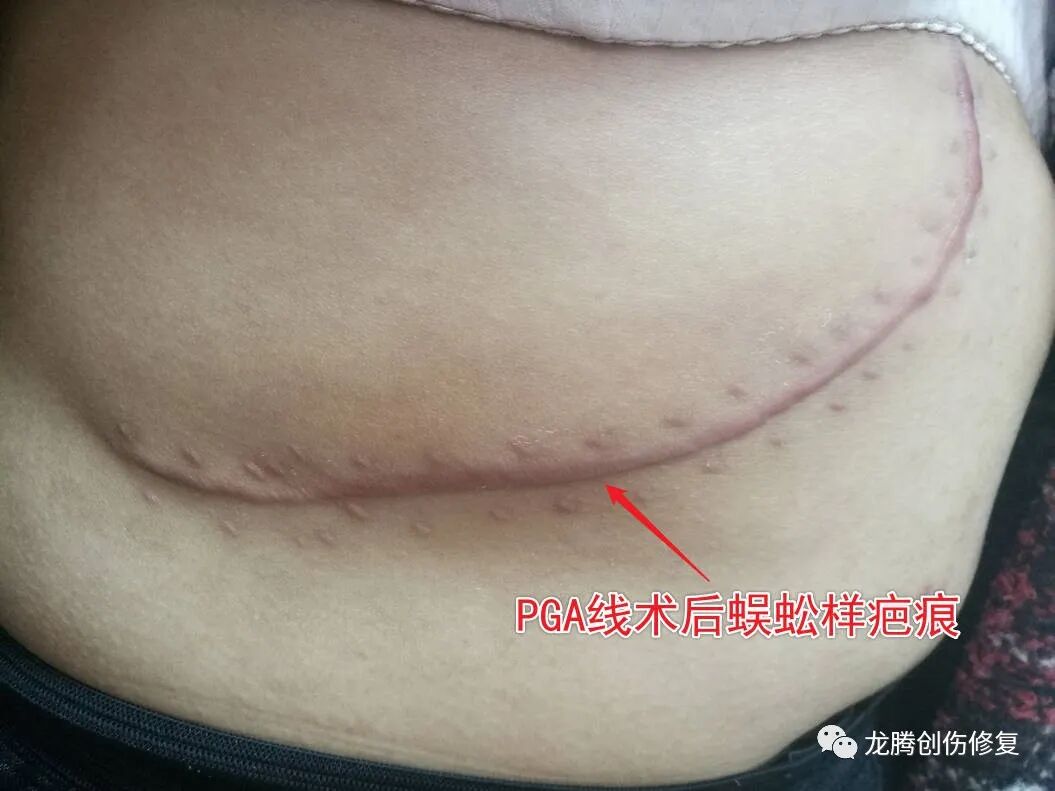 单股线怎么缝手术室常用缝合线，看这一篇就够了_https://www.jmylbn.com_新闻资讯_第4张