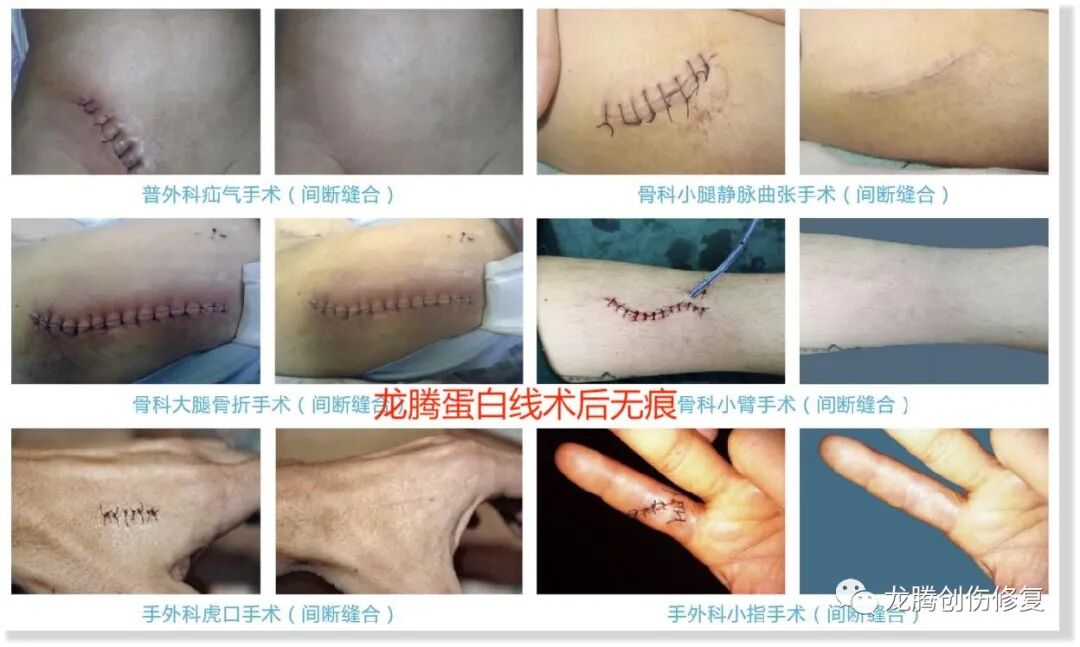 单股线怎么缝手术室常用缝合线，看这一篇就够了_https://www.jmylbn.com_新闻资讯_第5张