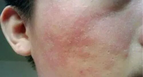 皮炎导致脂溢性皮炎的原因有哪些？