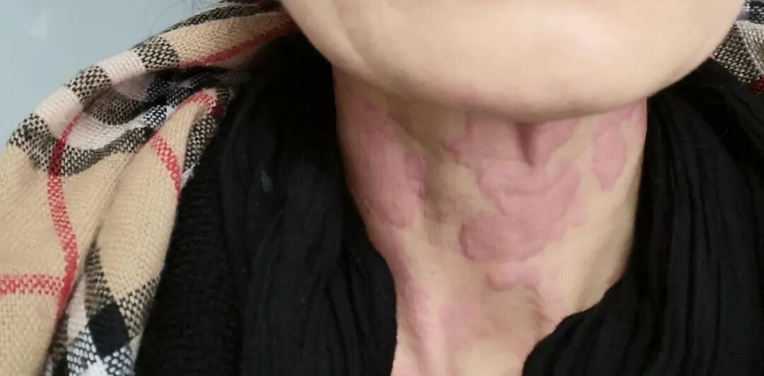 这种治不好的皮肤病叫做赤白游风，常被误认为是湿疹或者荨麻疹