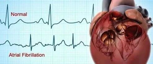 早读 | 心力衰竭合并心房颤动的导管消融治疗