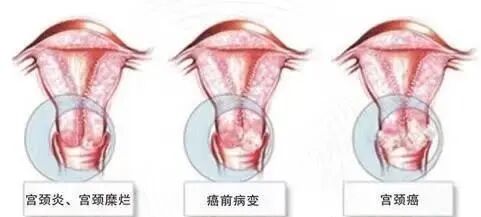 妇科leep刀怎么用【妇科科普】LEEP刀——让女人远离宫颈疾病_https://www.jmylbn.com_新闻资讯_第5张