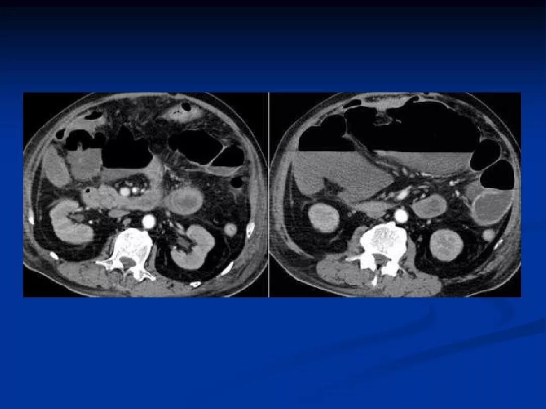急性肠系膜上动脉血栓该如何诊治一文了解