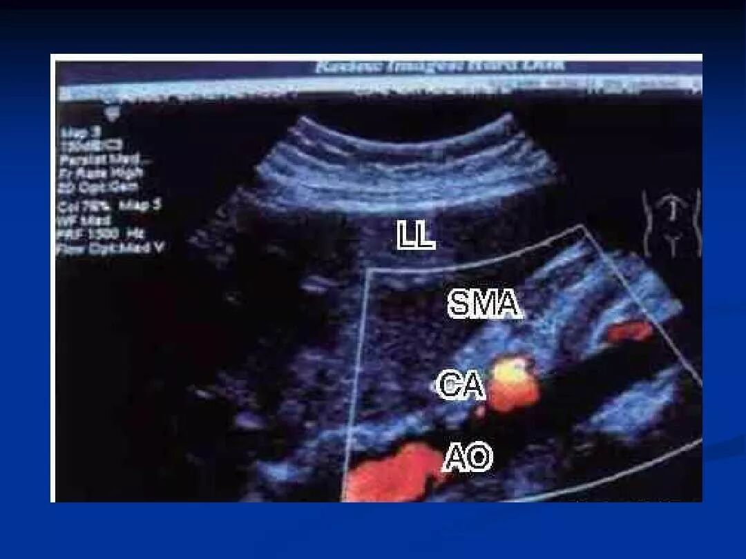 急性肠系膜上动脉血栓该如何诊治一文了解