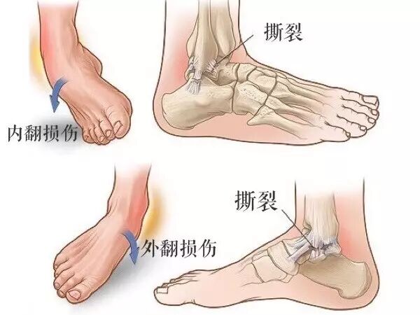 踝关节扭伤警察原则教你扭伤紧急处理