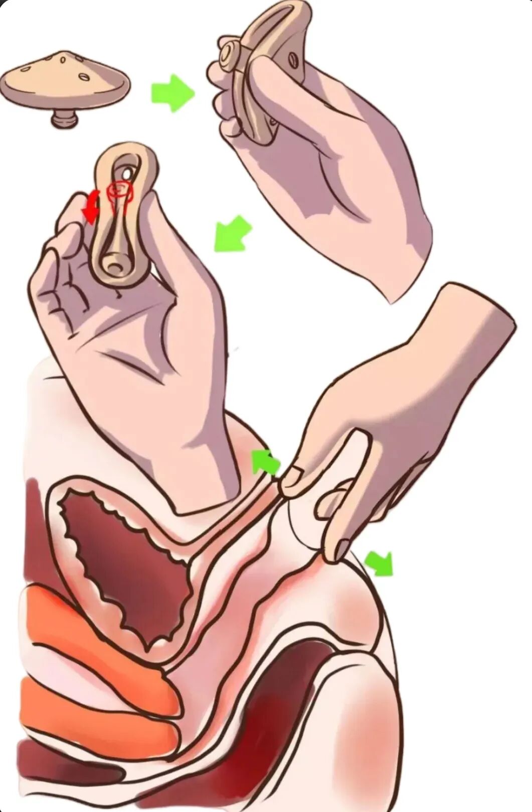 子宫支架怎么上告别“脱垂”与“漏尿”：阴道子宫托使用全指南_https://www.jmylbn.com_新闻资讯_第4张