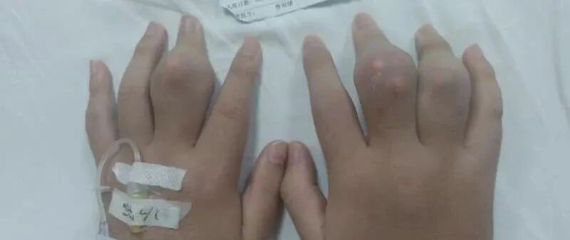 “每2天就要喝一次”！18岁“奶茶控”手脚关节长满“钻石”，无法走路……