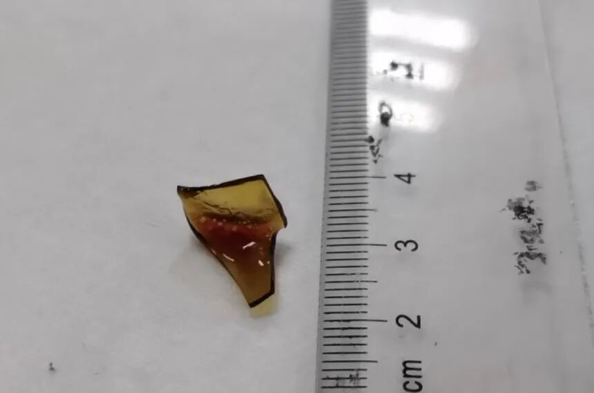 咳了半月痰中带血,女子吞下玻璃渣竟毫不知情!