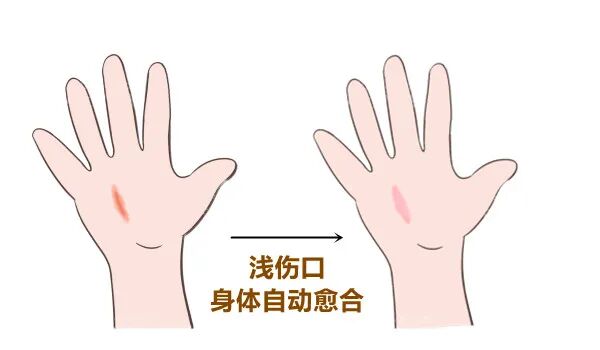 医用消疤贴怎么用大白话说中医第五百八十四期｜秦艽加上白僵蚕，祛斑消疤不麻烦_https://www.jmylbn.com_新闻资讯_第12张