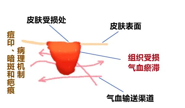 医用消疤贴怎么用大白话说中医第五百八十四期｜秦艽加上白僵蚕，祛斑消疤不麻烦_https://www.jmylbn.com_新闻资讯_第8张