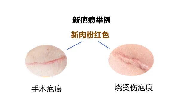 医用消疤贴怎么用大白话说中医第五百八十四期｜秦艽加上白僵蚕，祛斑消疤不麻烦_https://www.jmylbn.com_新闻资讯_第6张