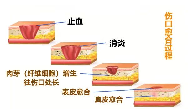 医用消疤贴怎么用大白话说中医第五百八十四期｜秦艽加上白僵蚕，祛斑消疤不麻烦_https://www.jmylbn.com_新闻资讯_第16张