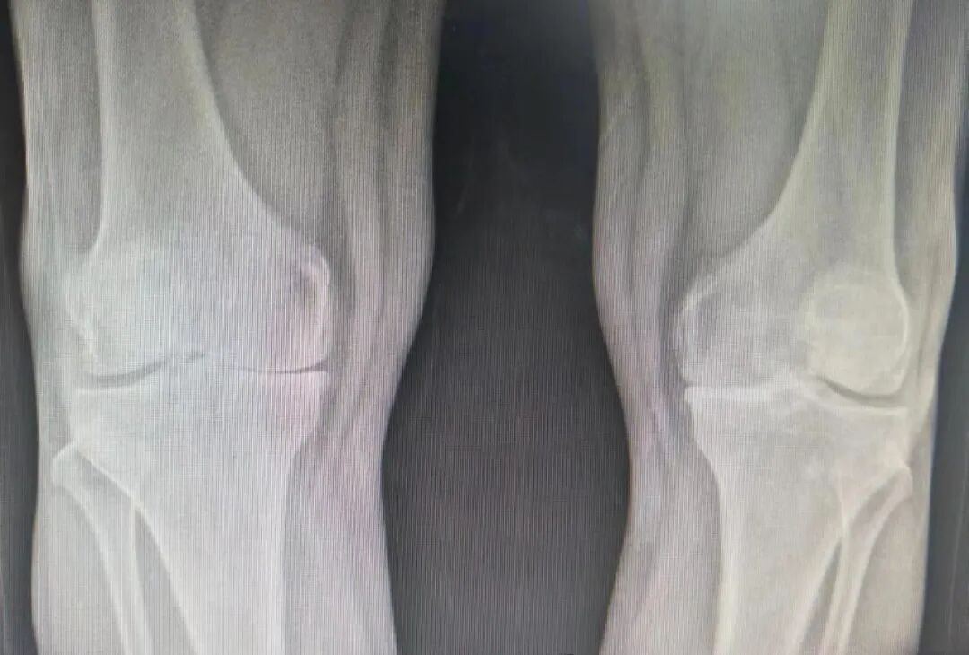 骨科什么耗材比较好卖好消息！国家集采骨科耗材在荣昌棠城、康弗尔医院落地，平均降价逾80%！人工关节正式进入“千元时代”_https://www.jmylbn.com_新闻资讯_第4张