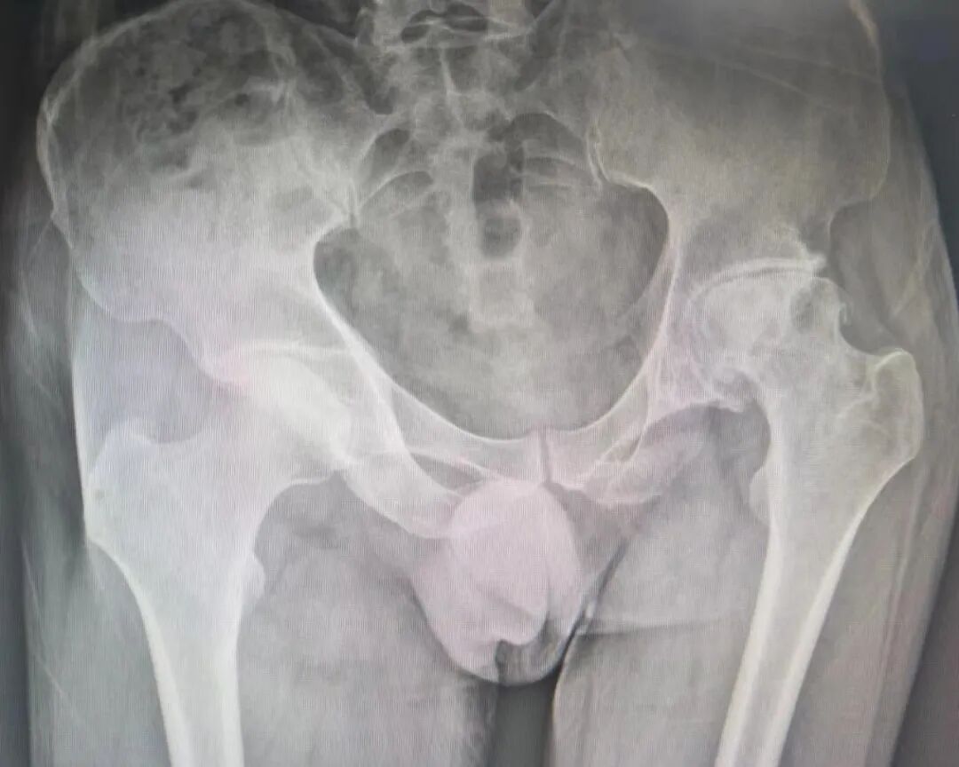 骨科什么耗材比较好卖好消息！国家集采骨科耗材在荣昌棠城、康弗尔医院落地，平均降价逾80%！人工关节正式进入“千元时代”_https://www.jmylbn.com_新闻资讯_第2张