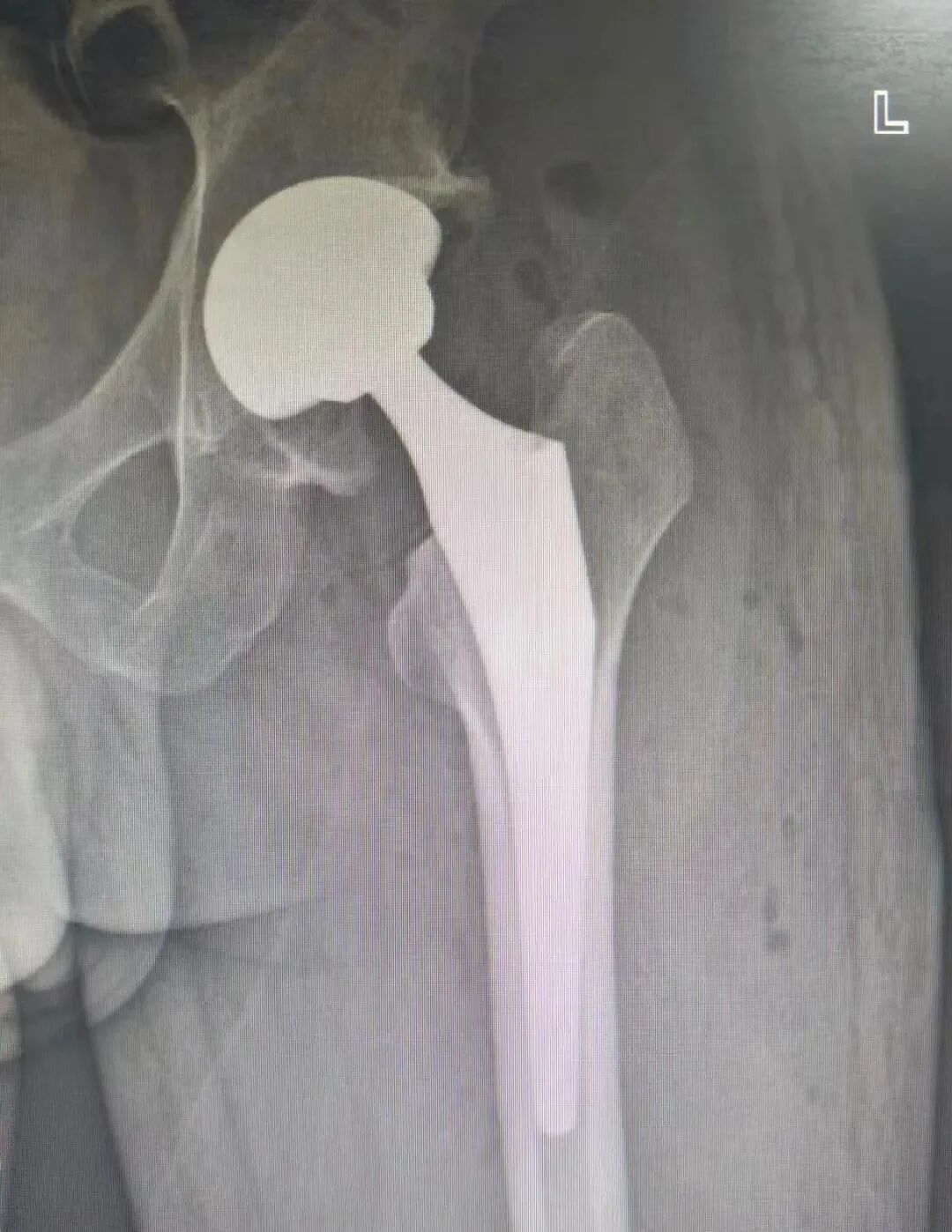 骨科什么耗材比较好卖好消息！国家集采骨科耗材在荣昌棠城、康弗尔医院落地，平均降价逾80%！人工关节正式进入“千元时代”_https://www.jmylbn.com_新闻资讯_第3张