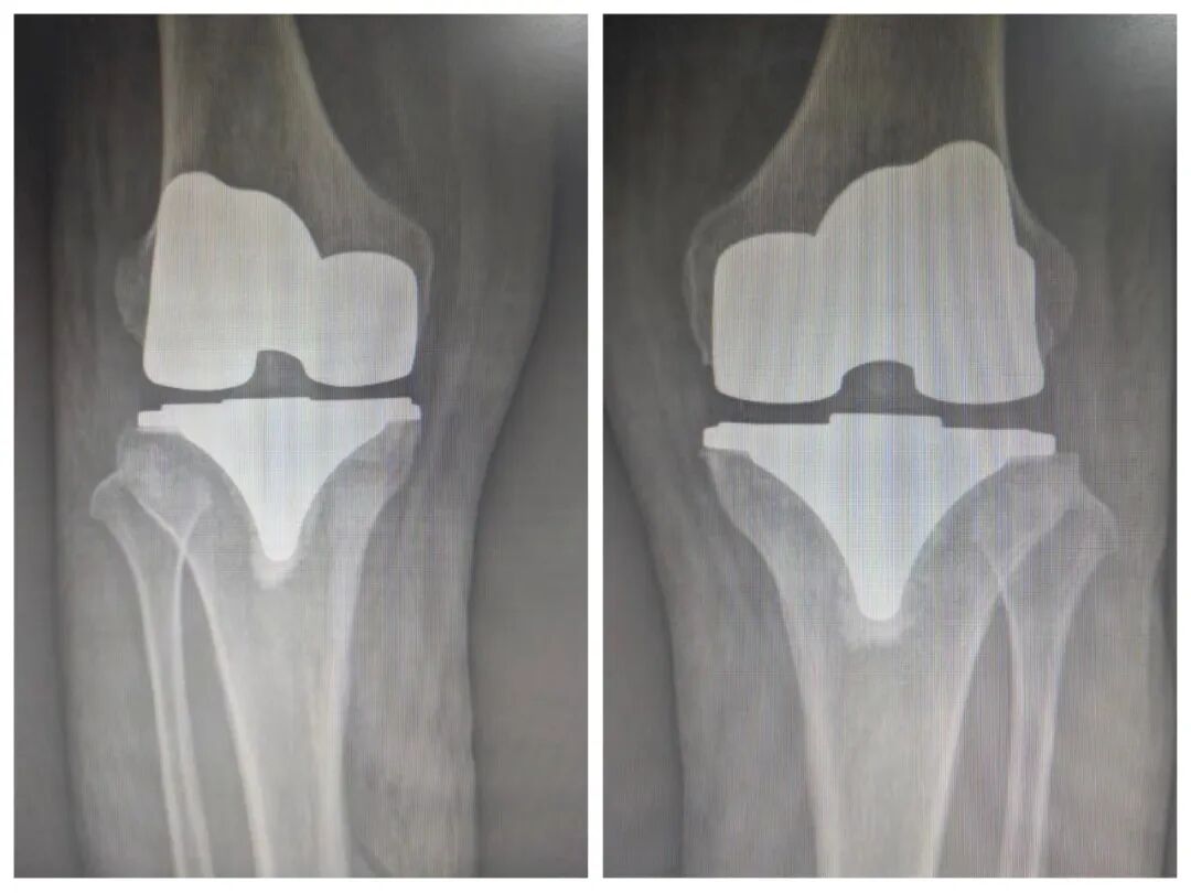 骨科什么耗材比较好卖好消息！国家集采骨科耗材在荣昌棠城、康弗尔医院落地，平均降价逾80%！人工关节正式进入“千元时代”_https://www.jmylbn.com_新闻资讯_第5张