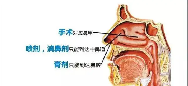 秋季鼻炎高发,做到这4点,鼻炎无法再近身! 秋季鼻炎高发,做到这4点,鼻炎无法再近身!
