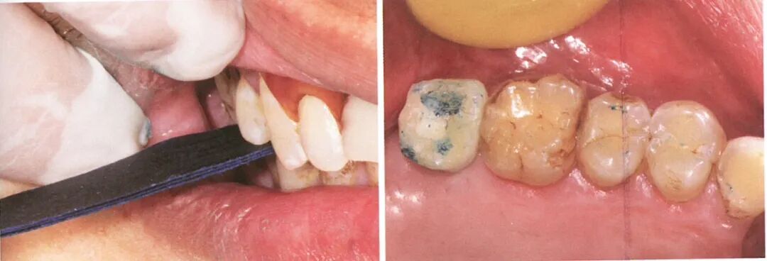 种植修复距离不足的解决办法（二）