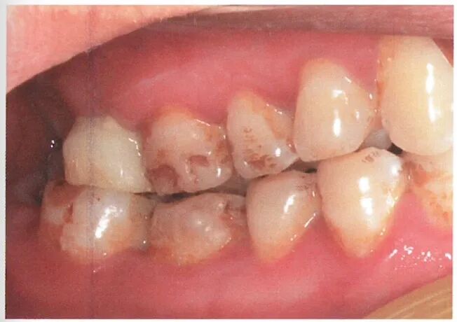种植修复距离不足的解决办法（二）