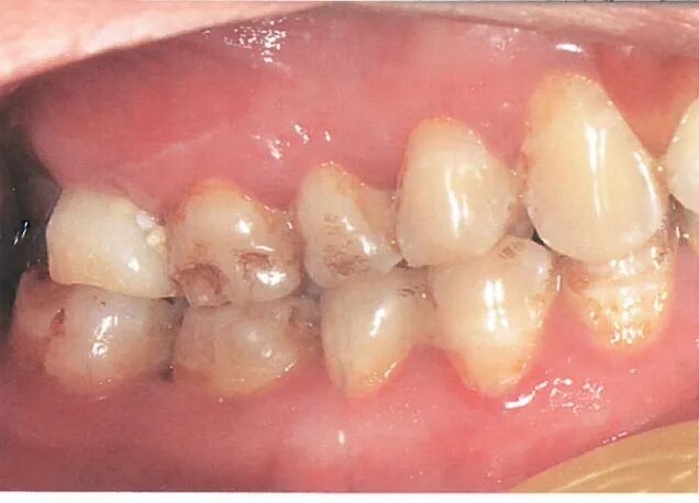 种植修复距离不足的解决办法（二）