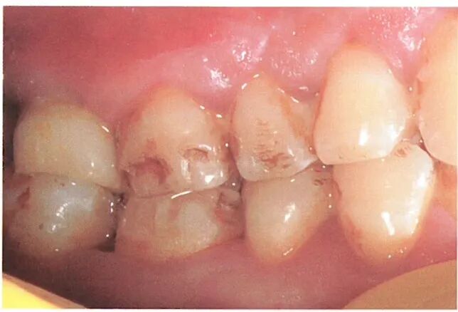 种植修复距离不足的解决办法（二）