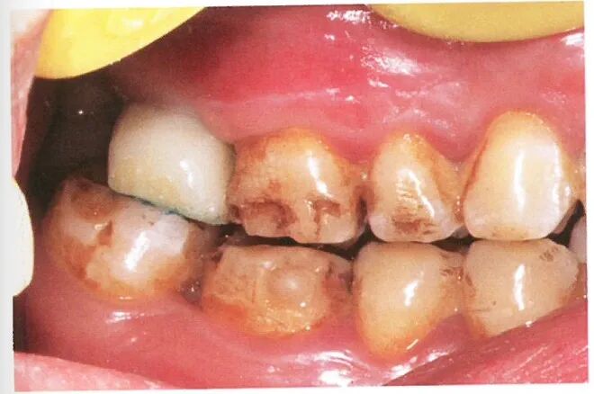 种植修复距离不足的解决办法（二）
