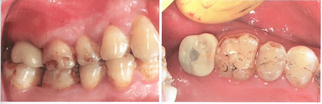 种植修复距离不足的解决办法（二）