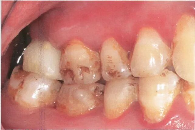 种植修复距离不足的解决办法（二）