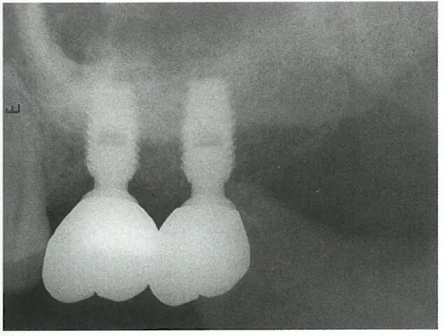 种植修复距离不足的解决办法（一）
