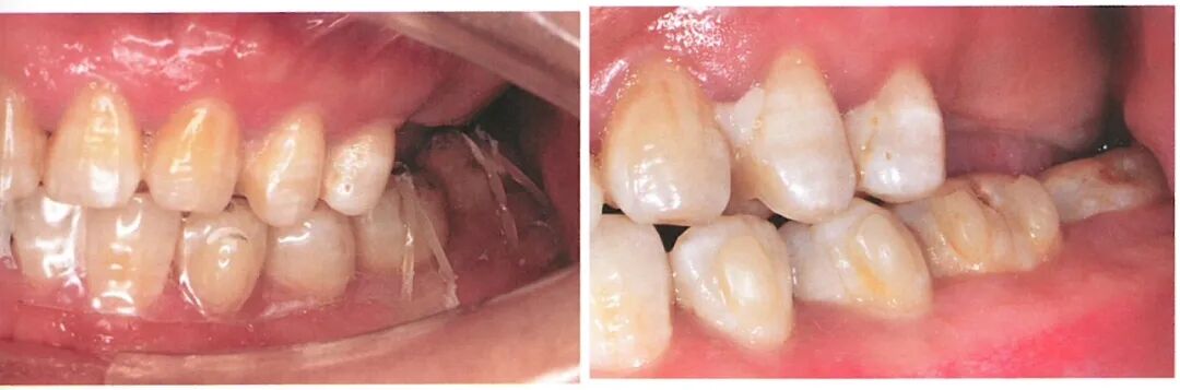 种植修复距离不足的解决办法（一）