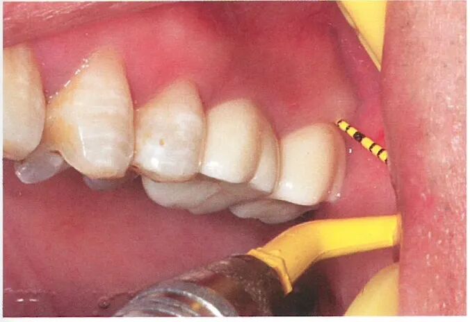 种植修复距离不足的解决办法（一）