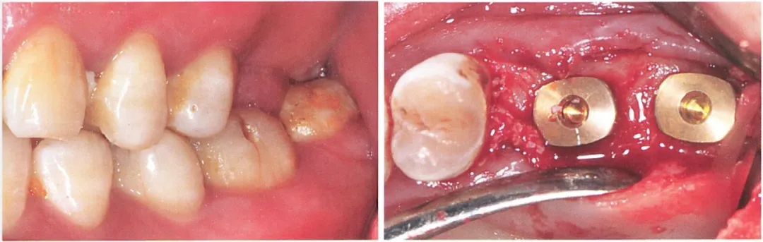 种植修复距离不足的解决办法（一）