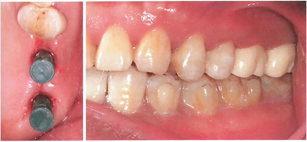 种植修复距离不足的解决办法（一）